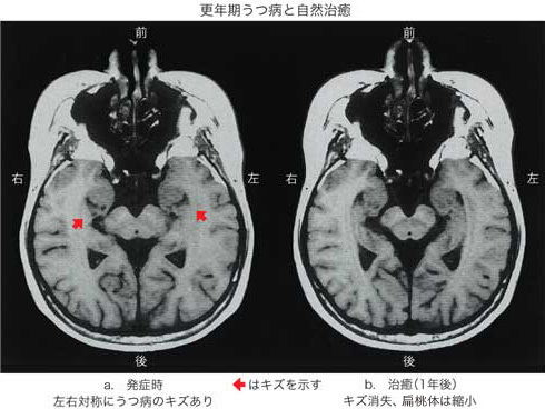 扁桃体 心の病は脳の傷 Iherbやひまし油の使い方 そこそこホリスティック